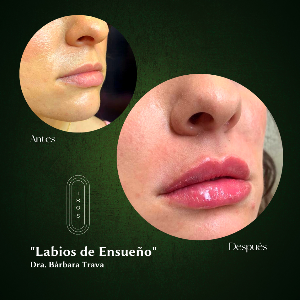 Aumento de labios 2